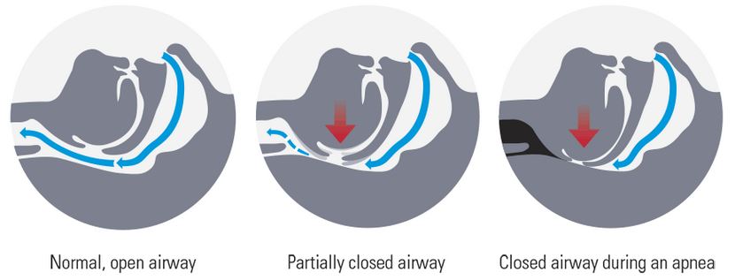snoring-and-sleep-apnea-diagram