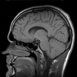 brain-central-sleep-apnea