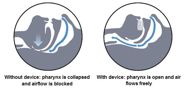 dental-device-sleep-apnea-treatment