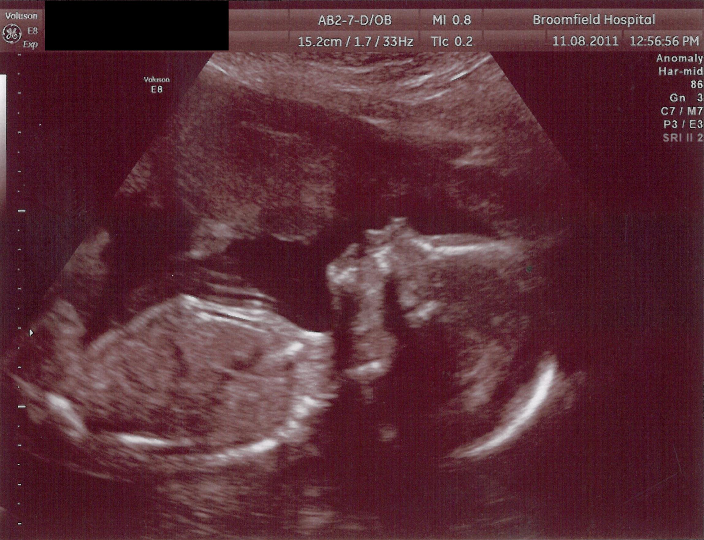 pregnancy_and_osa