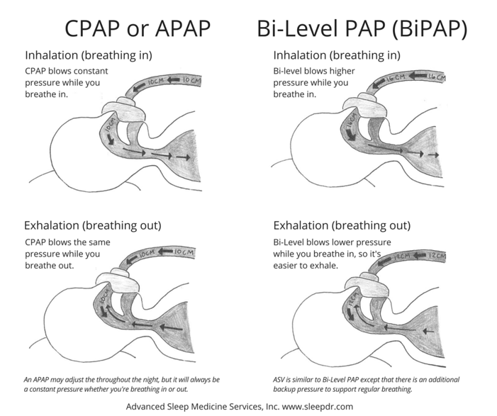 CPAP_vs_BiPAP_1.png