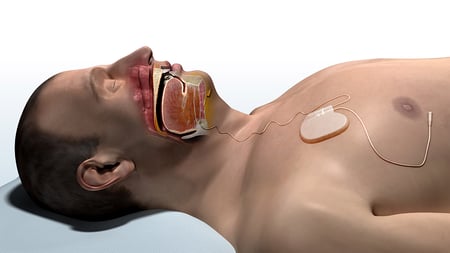 inspire-upper-airway-stimulation-diagram